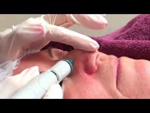 Blackhead removal with Hydrafacial