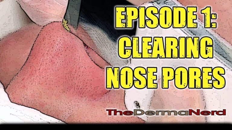 Episode 1: Clearing Nose Pores | Ultrasonic Extraction | Esthetician Demo