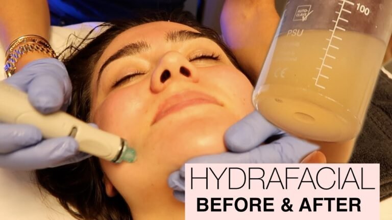 Getting My Pores SUCKED CLEAN! My First HydraFacial Experience: Before & After