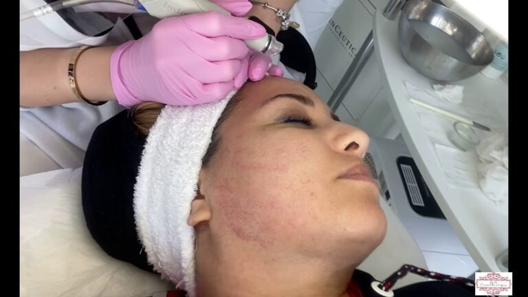 HYDRAFACIAL EXPERIENCE / تجربتي مع الهايدرا فايشل  اوالتنظيف العميف في تركيا🤫 هل يستحق🤔🤔
