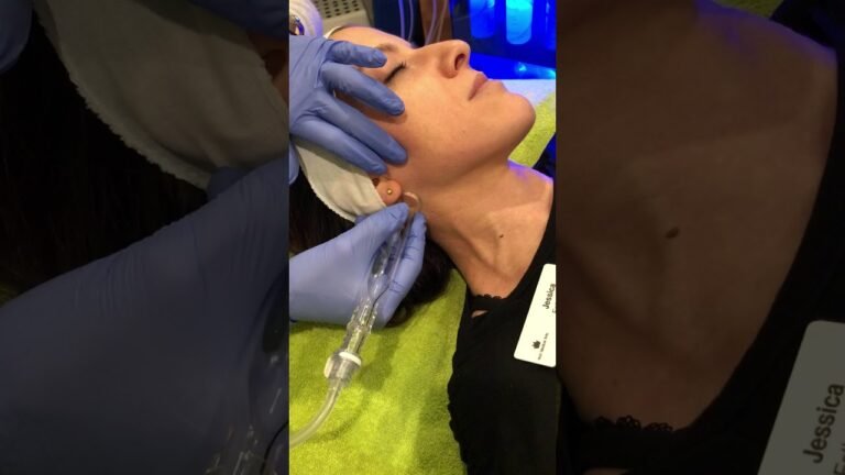 Lymphatic drainage with the Hydrafacial