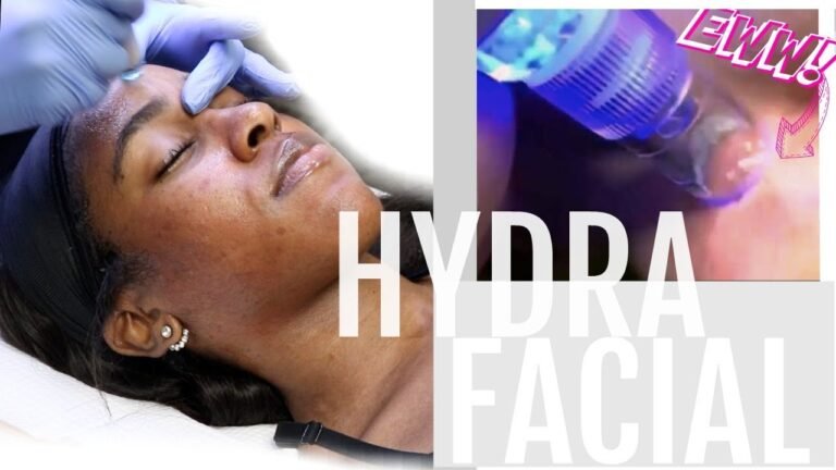 THAT Came Out of My Face?!| PORE VACUUM SUCTION| My HydraFacial Experience