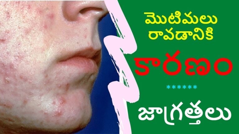 Acne symptoms and causes | | Dr Shalini Priya | Dermatologist | Cosmetologist |