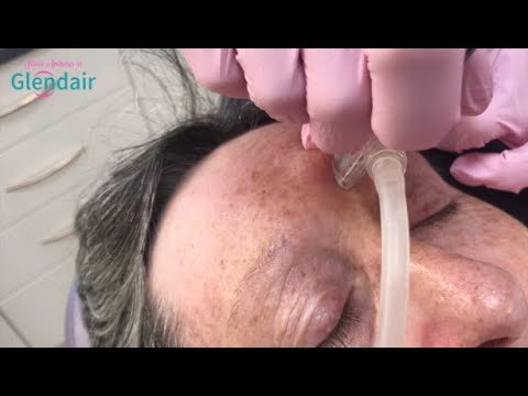 Blackhead Extraction using Face Perk™ by HydraFacial | Open Comedone Removal