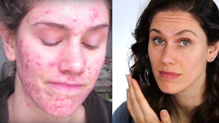 Esthetician Reacts To Horrific Cystic Acne Video That Went Viral 10 Years Ago Today…