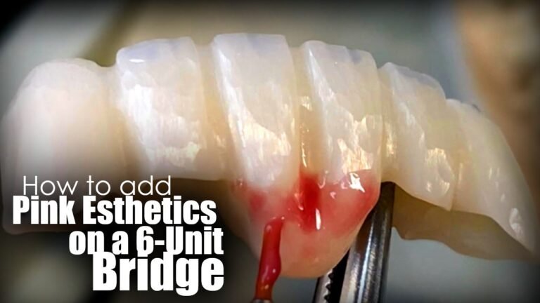 How to Add Life-Like Tissue Esthetics to a 6-Unit Bridge