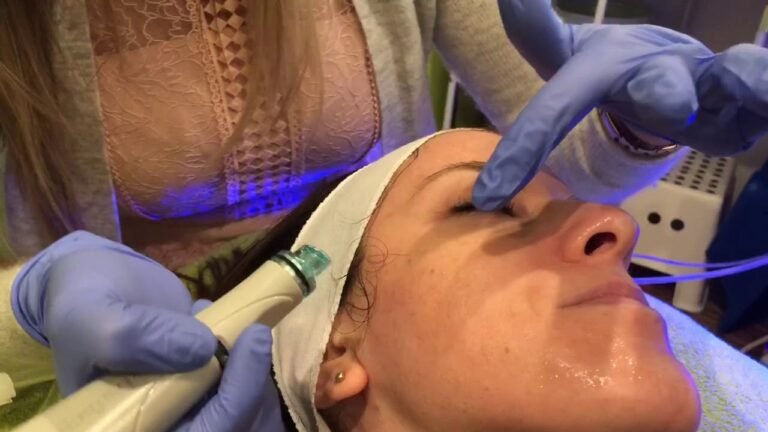 Hydrafacial extractions