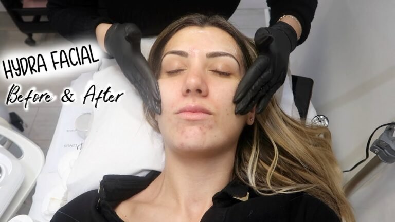 I GOT THE AQUA/HYDRA FACIAL | BEFORE – DURING – AFTER | IS IT WORTH IT??