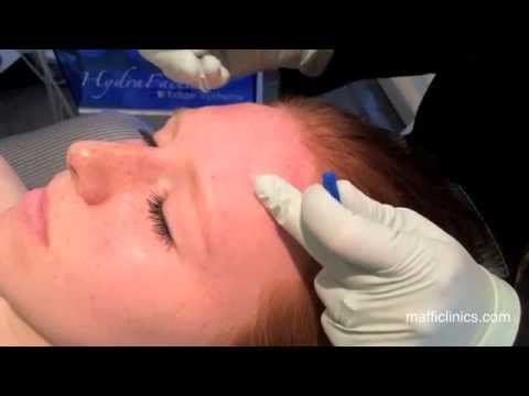 Maffi Clinics: Hydrafacial for Teen Acne