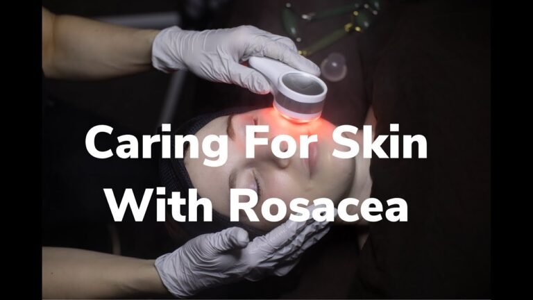 What is Rosacea? | Esthetician Explains