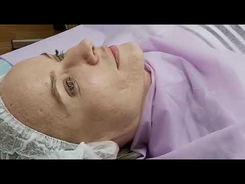 Пилинг для лифтинга и омолаживания кожи лица.