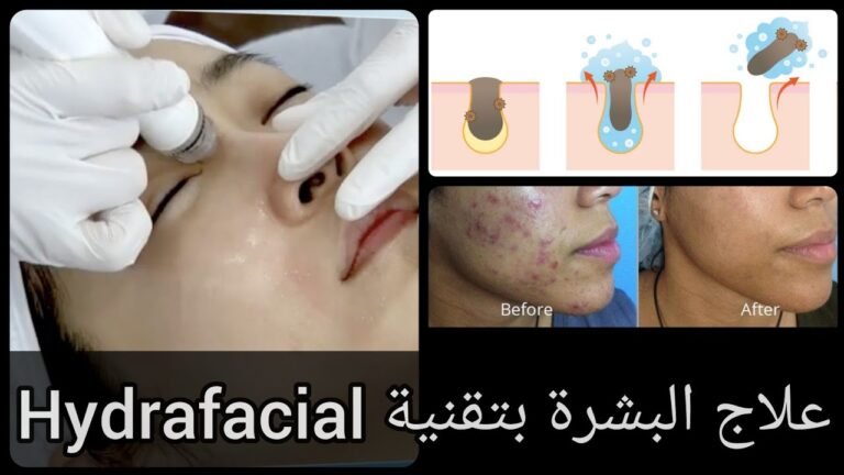 وداعا للكلف و البقع والمسامات الواسعة مع جلسات تنظيف Hydrafacial  احدث طريقة لتنظيف الوجه 💫